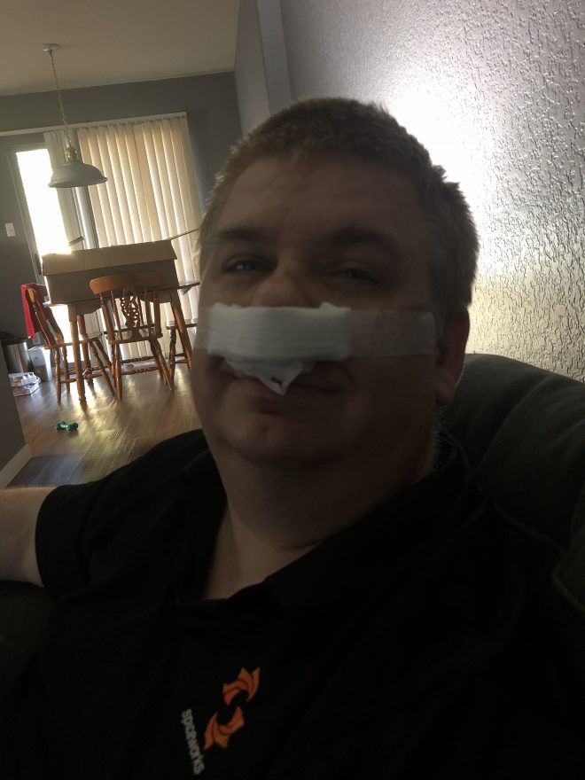 After Surgery for a deviated septum